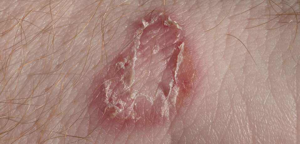 Ringworm Lesion on White Skin