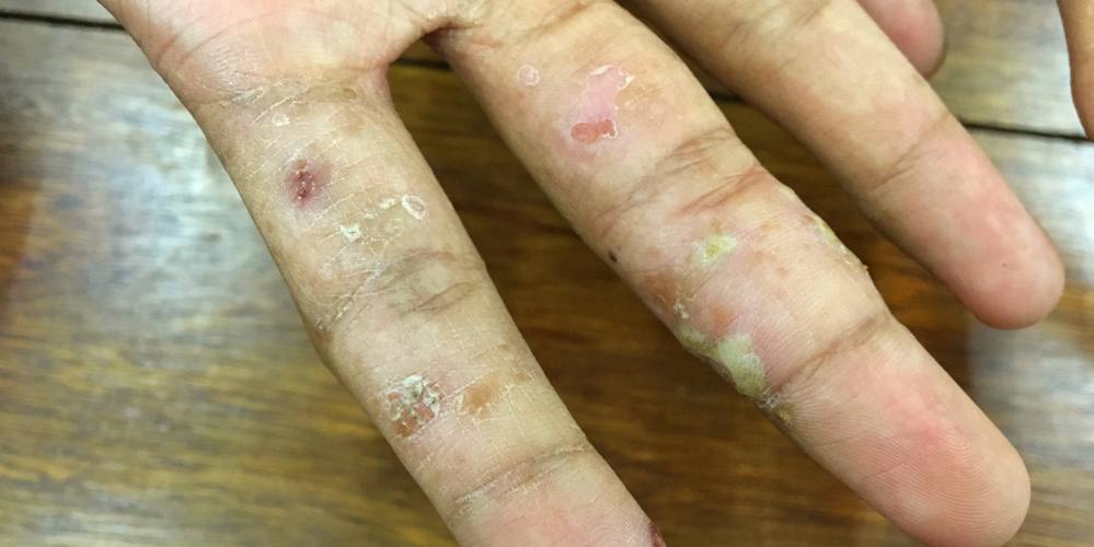 Man with Scabies on Hand