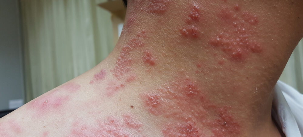 Shingles on Neck and Shoulders of Man
