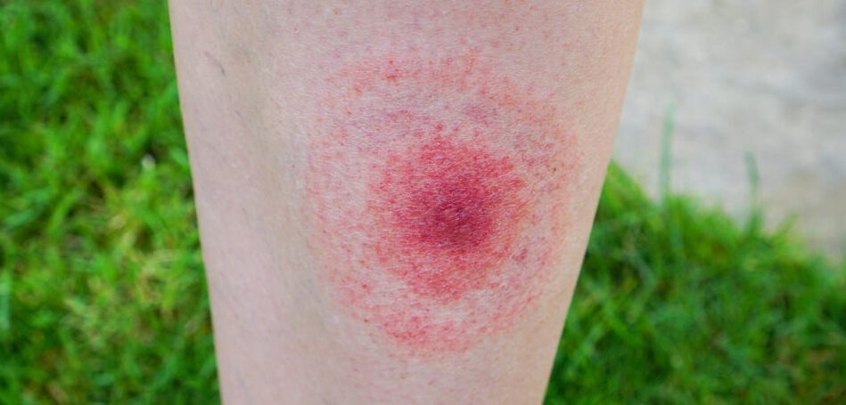 Lyme Disease on Leg of Woman