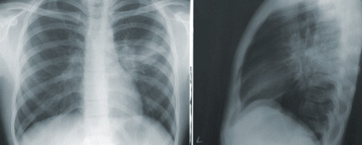 X-ray of Chest and Lungs